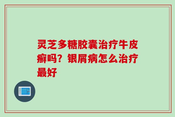 灵芝多糖胶囊治疗牛皮癣吗？银屑病怎么治疗最好